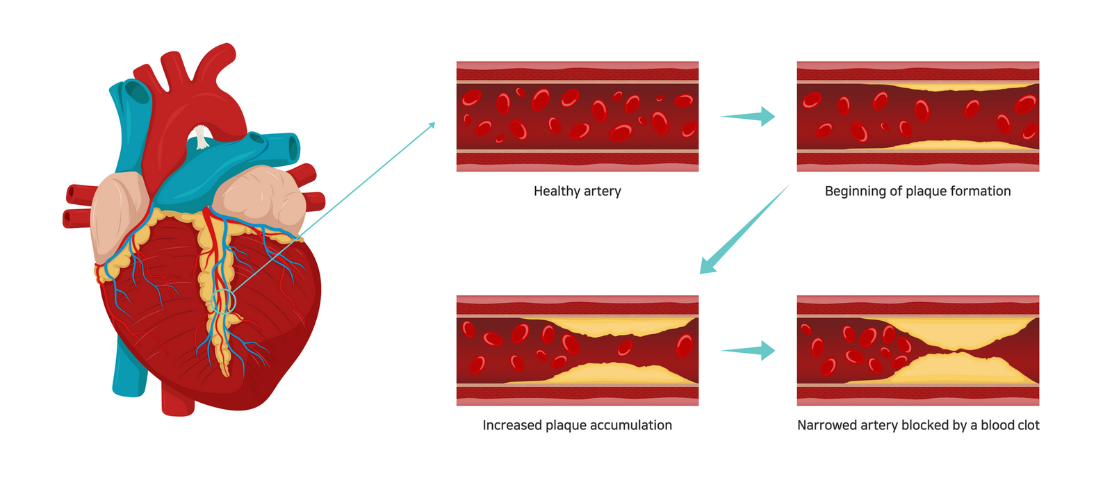 Atherosclerosis i Stock 1173983141 edited 01