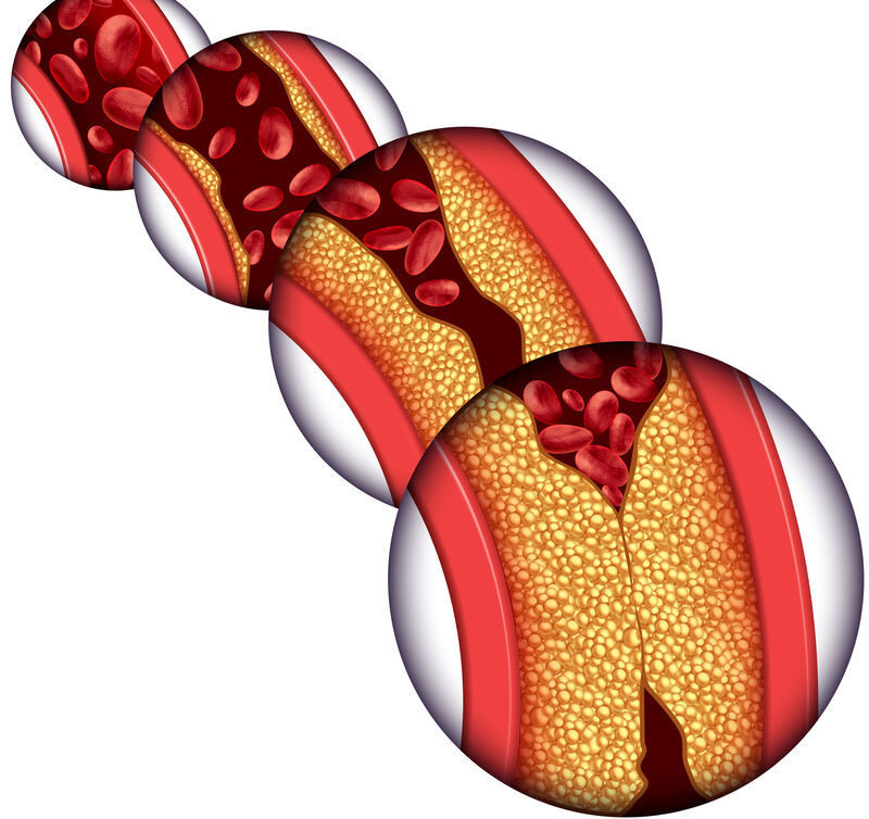 Atherosclerosis i Stock 1026729722