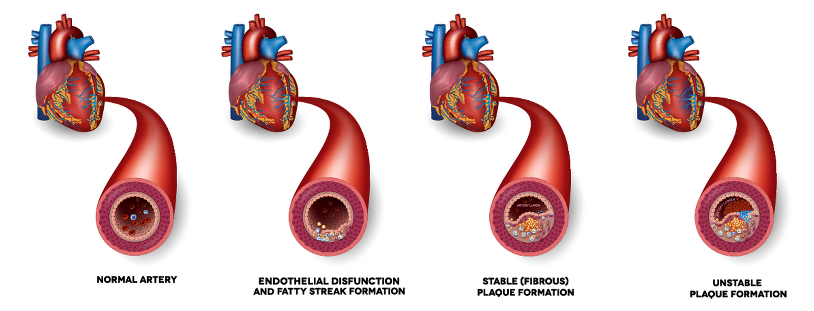 Atherosclerotic plaque