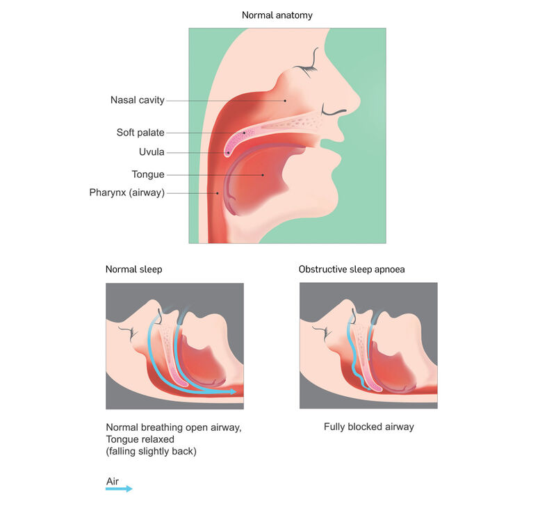 Obstructive sleep apnoea 70458322 m