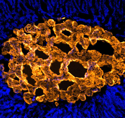 Coronary-Disease-banner